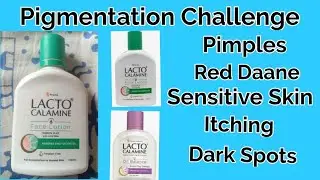 Pigmentation challenge Lacto calamine face lotion for itching, pimples, sensitive skin, red skin