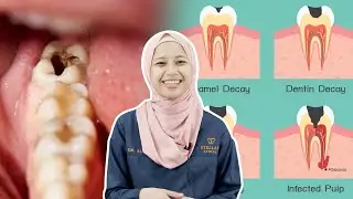 Punca Gigi Anda Berlubang