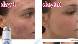 Acne Laser Pen Portable Wrinkle Removal Machine Durable Soft Scar Remover Device Blue Light #shorts