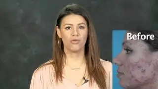 AvaMD Acne Patient Testimonial: Karla
