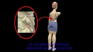 Hernia de Disco, Extrusão, Protusão e Abaulamento. Como causam Dor no Ciatico,  Dor nas Costas, etc.