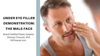 Dark Eye Circles in Men: Filler Demonstration-Part 1- by Plastic Surgeon, Ramsey Choucair, M.D.