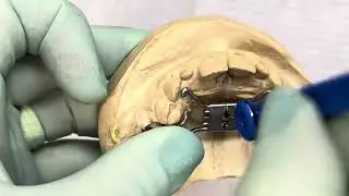Como ativar o disjuntor maxilar (expansor fixo da maxila)? Passo a passo