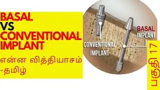 Basal Vs Conventional implant | Cost of full mouth basal implant in Chennai | Dr.MKP | SDC