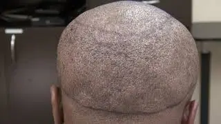Hair Transplant FUE Donor Scar Results Men Hair Loss Fix by Dr Diep Hair Restoration Doctor