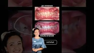Как вам результат? #стоматология  #дубай #dentalclinic #dubai #invisalign #ортодонтия