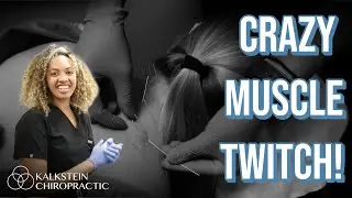 Dry Needling for Upper Trap Tightness | Muscle Twitch Release & Pain Relief Treatment in Towson, MD