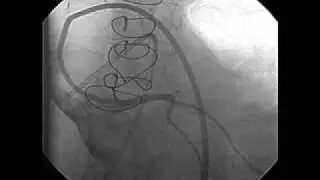 Left Ventricular Dysfunction after Heart Transplantation