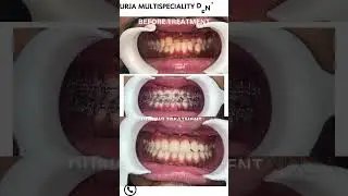 Top dental clinic in mohali is Urja Multispeciality Dental Clinic. Dental Clinic in 3B2 Mohali