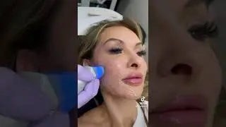 Exilis Skin Tightening