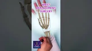 Total Wrist Arthroplasty - Wrist Replacement Surgery