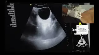 ECOGRAFÍA CLÍNICA ABDOMINAL EN EL DIA A DIA DE LA CONSULTA DEL MÉDICO DE FAMILIA POCUS Dr Estelrich.