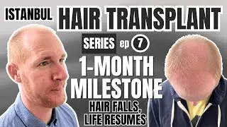1 Month After My Hair Transplant (Recovery & Expectations)