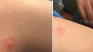 Комик из Лас-Вегаса госпитализирован после укусов этих насекомых, которые привели к серьезной инф...