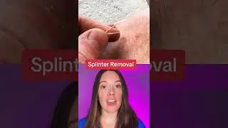 Splinter Removal