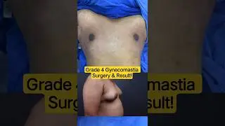 Severe Man Boobs (Grade 4) &ndash; Best Surgical Solution Gynecomastia | Dr DC Plastic Surgeon Pune