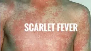 Scarlet Fever / Continue to rise / what you can do?