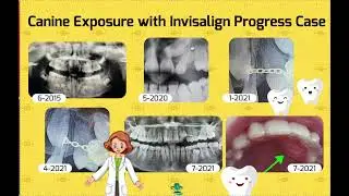 Canine Exposure with Invisalign Case Progress