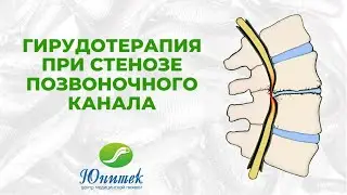 Гирудотерапия при стенозе позвоночного канала