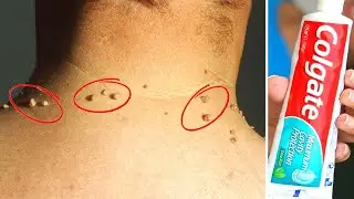 Remove Skin Tag in from Your Neck, Eyelids or Face With Colgate