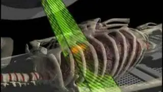 Cancer treatment with respiratory gating
