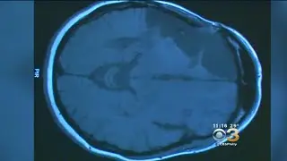 Too Much Stress Can Literally Shrink Your Brain, Experts Say