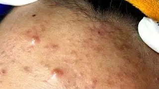 ASMR Extreme Deep Cleansing | Acne & Blackhead Removal | Satisfying Skin Care