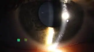 Epicapsular Stars Pigment on Anterior Lens from Iris