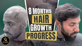 8 Months That Changed the Hairline 😍 | Hair Transplant in Raipur | New Roots