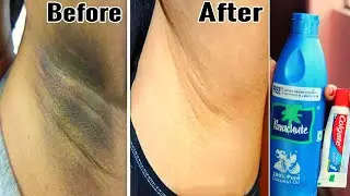 ಕಪ್ಪಾದ ಅಂಡರ್ ಆರ್ಮ್ಸ್ ಬಿಳಿಯಾಗಲು ಮನೆಮದ್ದು । underarms whitening home remedy