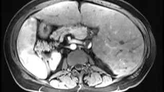 Situs Inversus