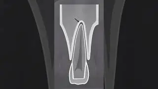est&aacute;gios da les&atilde;o periapical
