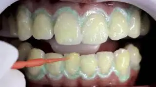 تبييض الاسنان في عيادة  طبيب الاسنان ( in_office_bleaching)