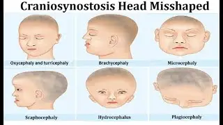 Craniosynostosis syndromes;  genetic conditions where premature fusion of skull sutures