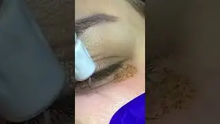 PLEXR Eye Lid Tightening &ndash; the non-surgical blepharoplasty! #shorts #DrBurhanClinic
