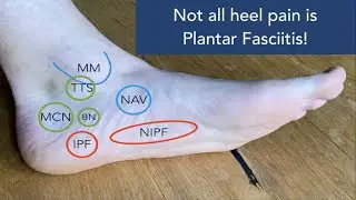 Not all heel pain is plantar fasciitis
