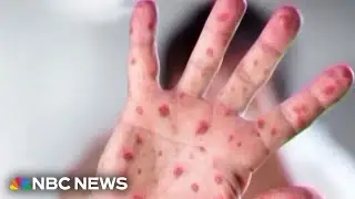 Los Angeles child dies of complications from measles virus