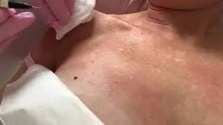Removal of Red Sun Spots | Appearances Aesthetics