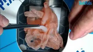 HOST - Supravalvular aortic stenosis repair (Inverted Y patch) on 3D model - Dr DJ Barron (FULL)