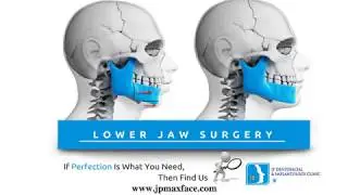 Lower Jaw Surgery In Thrissur | Corrective Jaw Surgery In Kerala | Jaw Deformity Treatment In India