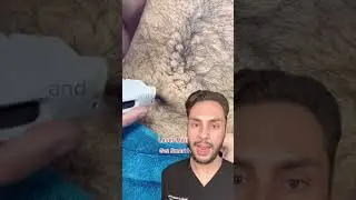 Laser Hair Removal FAIL | Laser Gone Wrong | MaximumSkin