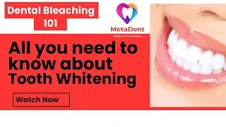 Dental Bleaching Explained: A Cosmetic Dentist's Guide to Teeth Whitening