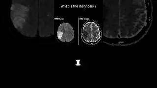 Diffusion weighted imaging &ndash; Infarct (brain) Quiz 19 #@radiologychannel007