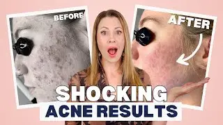 3 ‘Impossible’ Acne Cases Finally Cleared Fast (and How We Did It)
