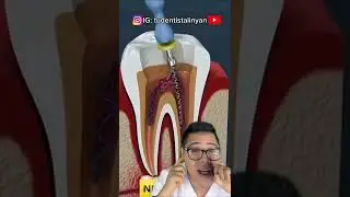 MuelinFlash #42: &iquest;Qu&eacute; es una F&Iacute;STULA DENTAL? 🦷🎤🧑🏻&zwj;⚕️