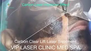 Carbon Clear Lift Laser Treatment - VIP Laser Clinic Med Spa - Mauritius