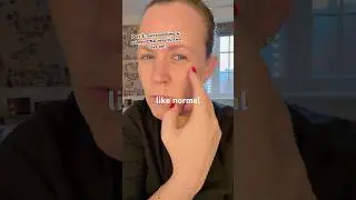 Pt 3: Salmon DNA + Microneedling = two days on! #microneedling #salmondna #facialtreatment #facial