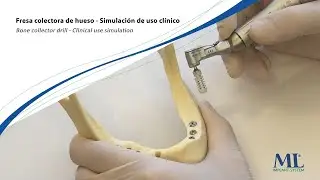 Fresa colectora de hueso ML - Simulaci&oacute;n de uso cl&iacute;nico | Bone collector drill - Clinical use