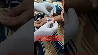 i.v cannula kaise nikale | How to remove IV cannula | Cannula Removal #cannula #iv #injection #short