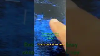 Breaking up kidney stones with no X-ray radiation #kidneystone  #fypシ゚viral